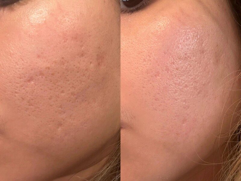 Traitement des Cicatrices d'Acné