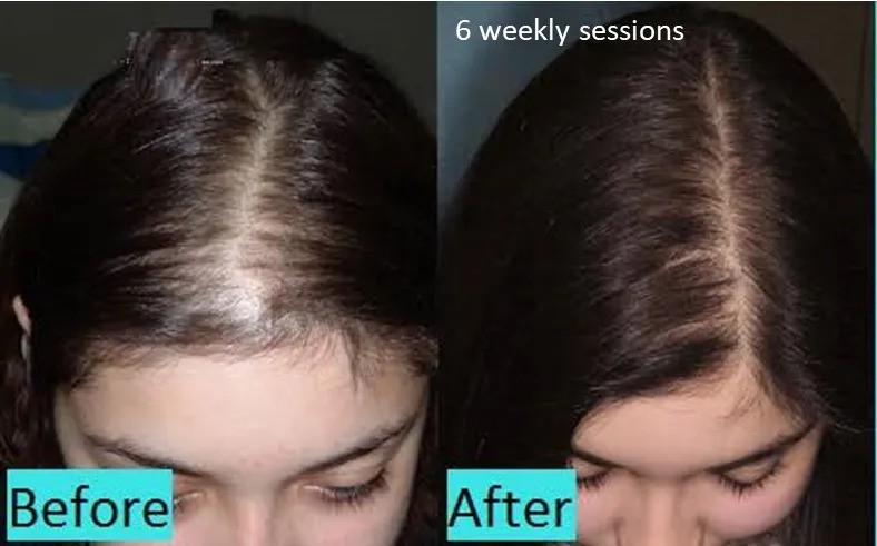 Traitement Hair Growth