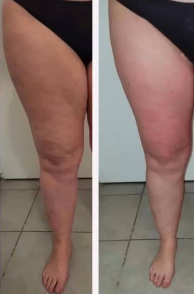 Lipocavitation et Radiofréquence